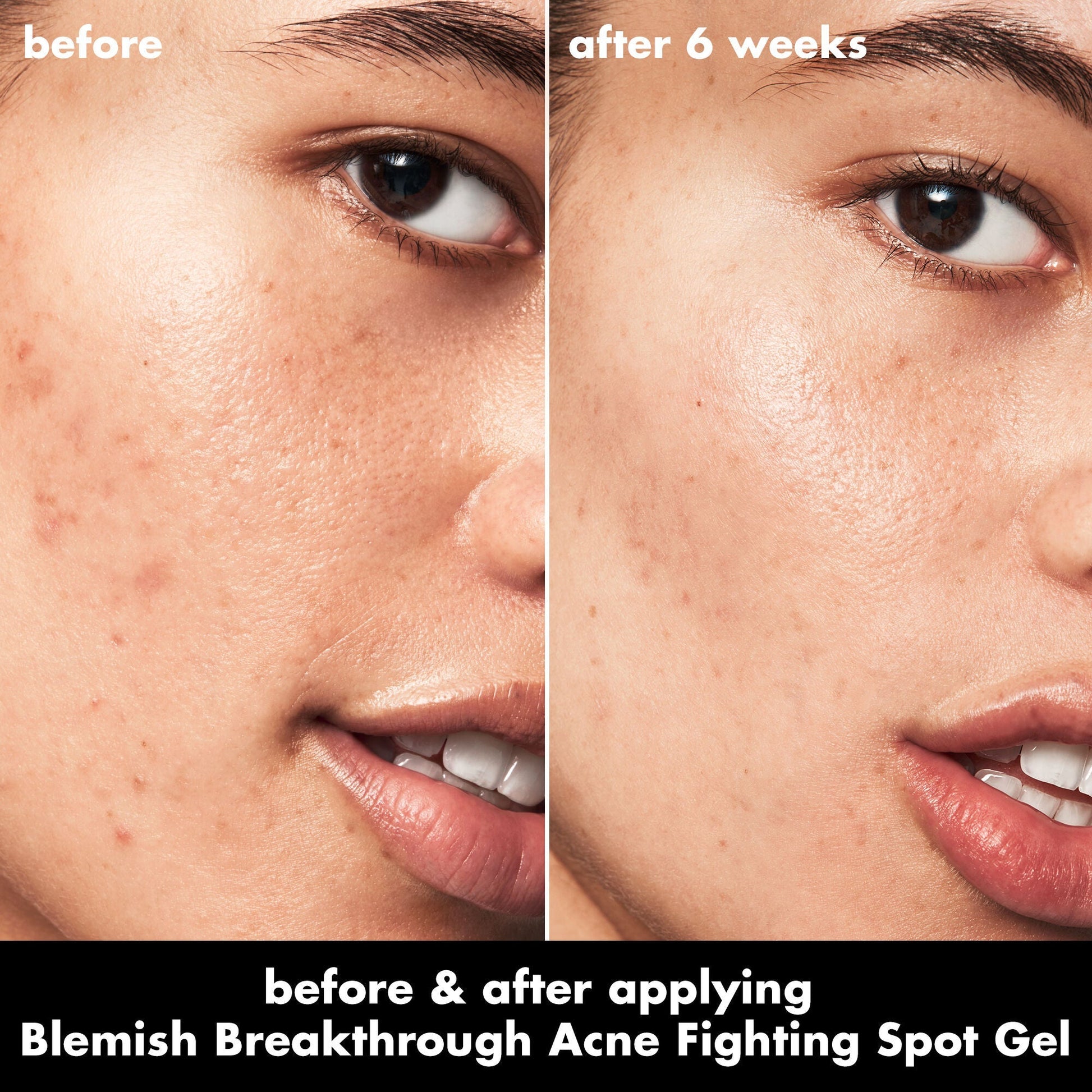 blemish-breakthrough-acne-fighting-spot-gel-n8 0326_EDU_BB_SpotGel_BA_ISABELLA.jpg