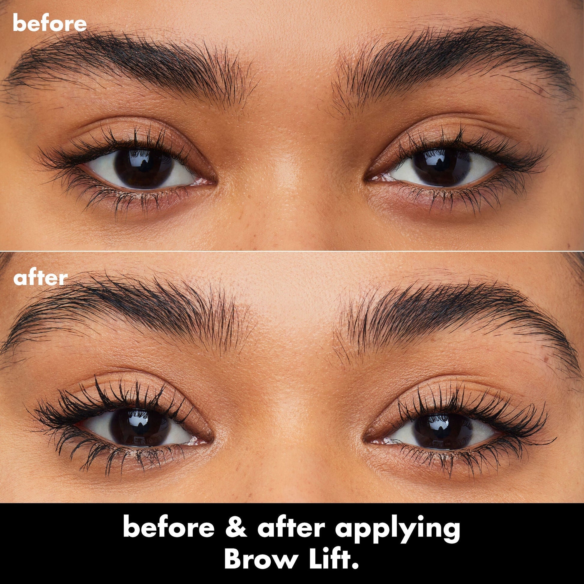 brow-lift-s0 0326_EDU_BrowLift_BA.jpg