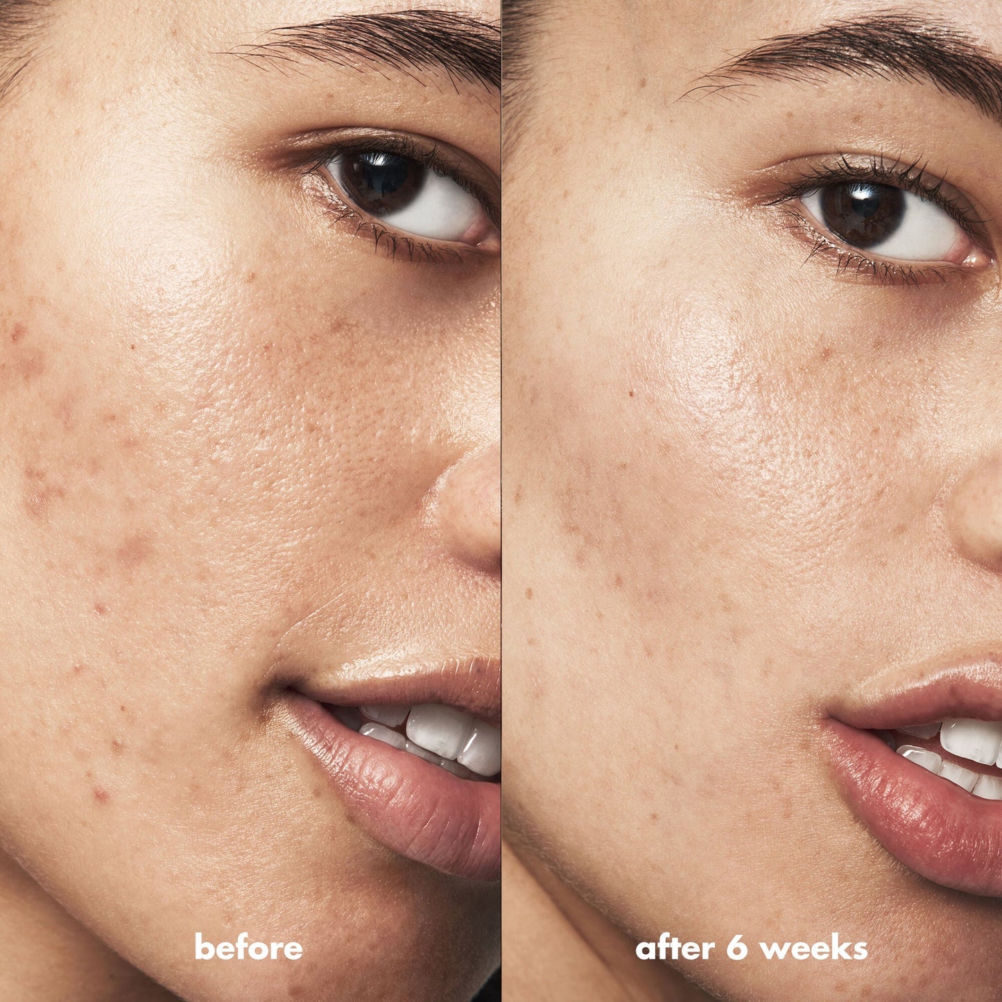 blemish-breakthrough-acne-calming-water-cream-mini-i6 Acne_PDP_Isabella_Before_After_f0d452cd-72f5-4bb8-a6df-0b3cc23143ef.jpg