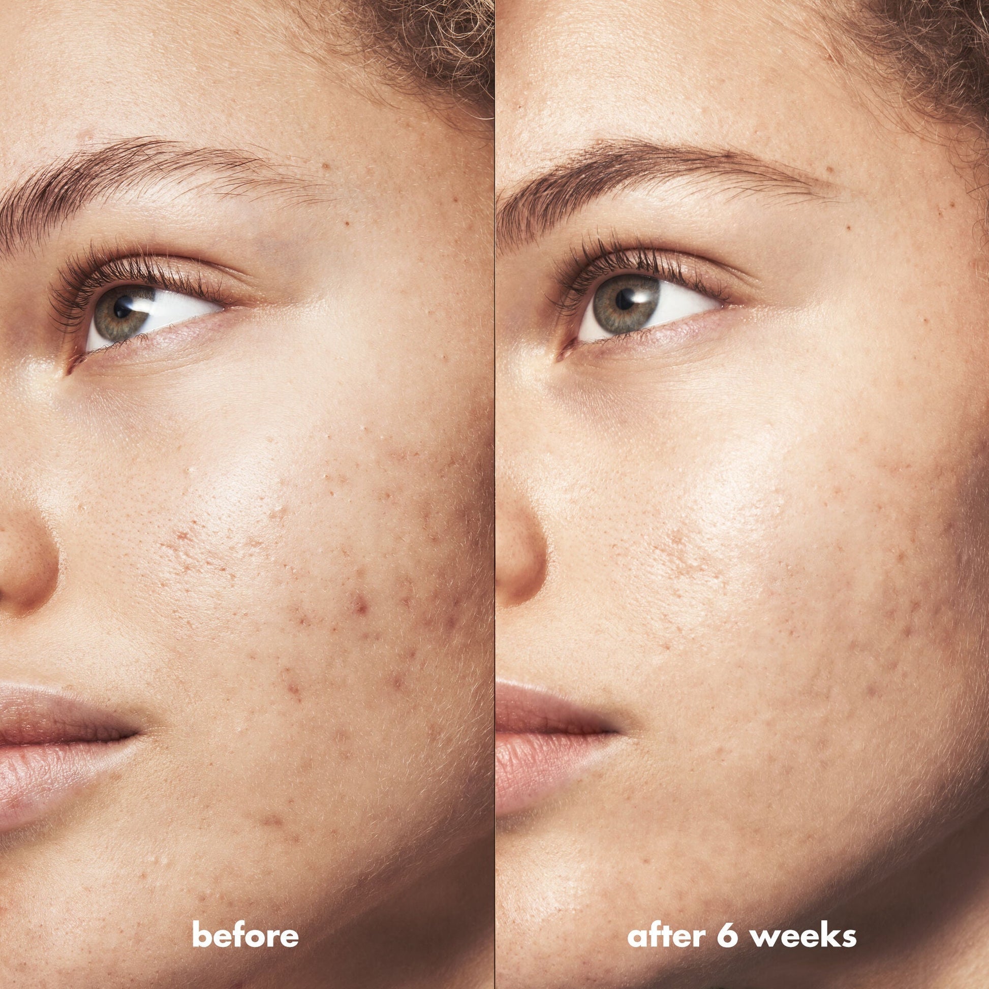 blemish-breakthrough-triple-acid-resurfacing-serum-h3 Acne_PDP_Marley_Before_After_1a95cac5-0af6-43b6-a936-d0bacbdec0bf.jpg